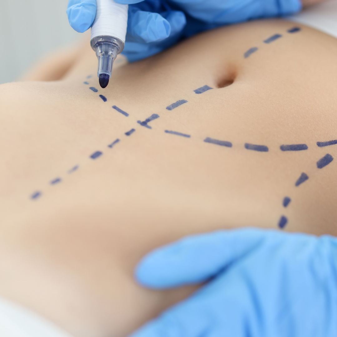 PAL® LipoSculptor: требования к оборудованию для бережного забора жировой ткани